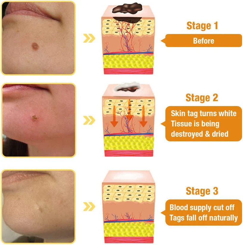 TagRecede Bee Venom Treatment Spray - Nilola