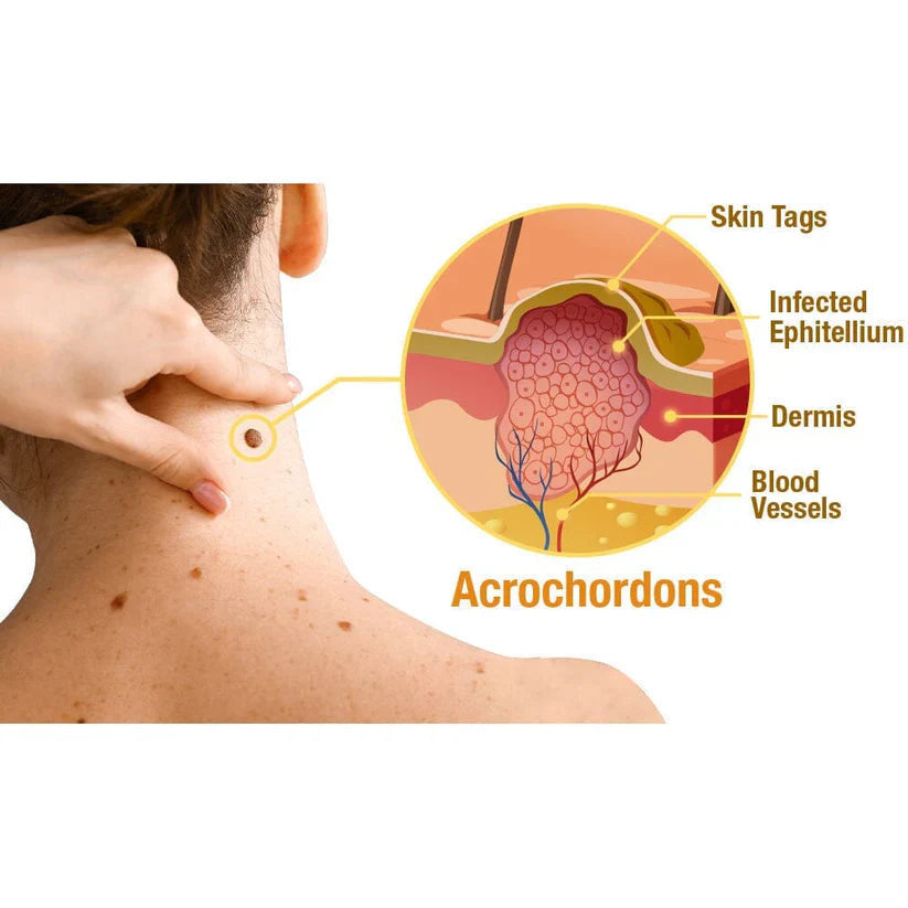 TagRecede Bee Venom Treatment Spray - Nilola