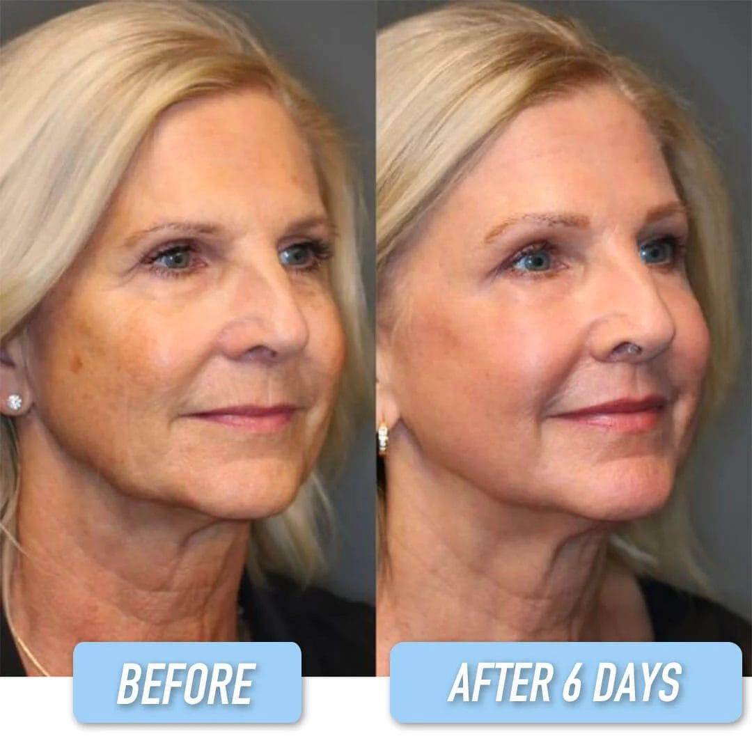 Lifting Face Mask - Hot Sale 50% Off